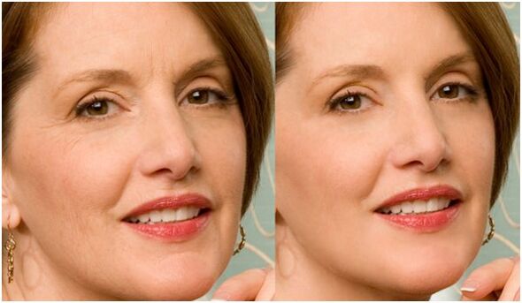 před a po plazmatickém omlazení pokožky obličeje
