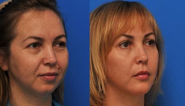 před a po omlazení pokožky pomocí napínací fotografie 1