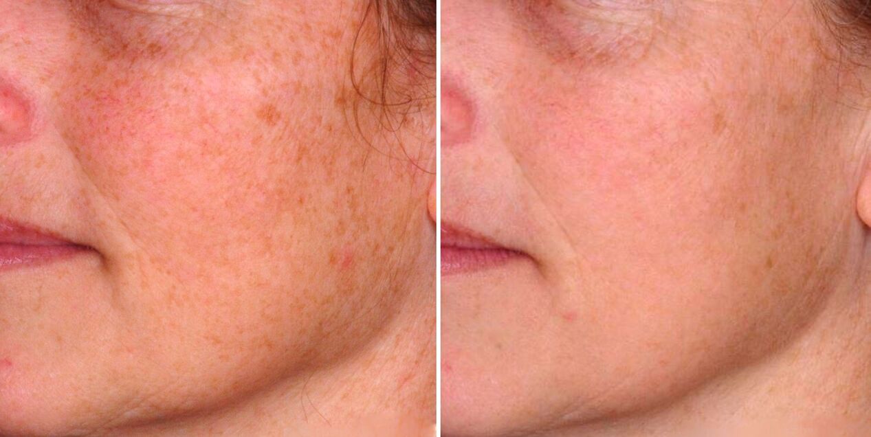 Výsledkem frakční fototermolýzy je redukce stařeckých skvrn na pokožce obličeje. 