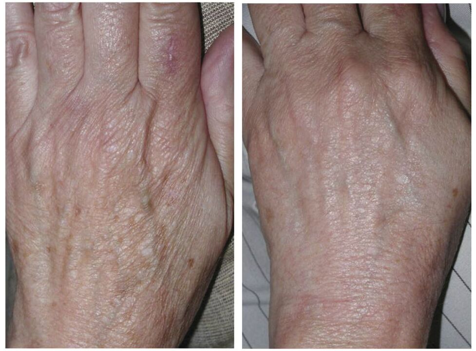 laserové omlazení rukou před a po fotografiích